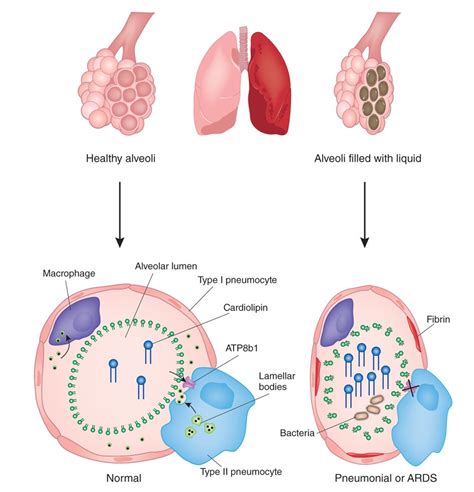 Surfactant homeostasis and proposed new model of lung dysfunction by cardiolipin in pneumonia ...