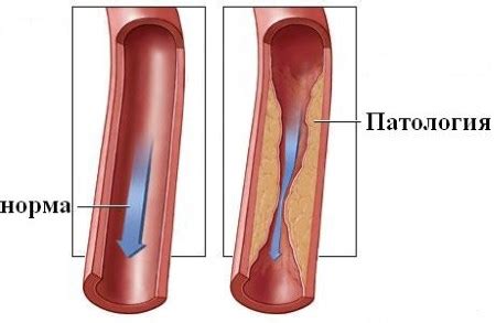 Stenosis of the vertebral artery: causes, symptoms, treatment