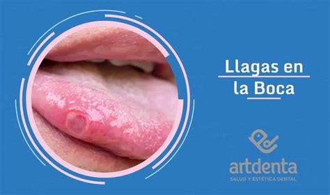 Llagas en la Boca | Clínica Dental en VALENCIA - Benimaclet