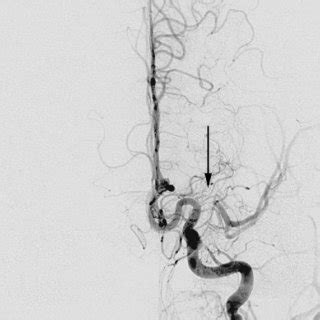 Left ICA angiogram demonstrates a high-grade stenosis of the proximal ...