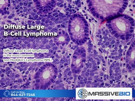 Diffuse Large B-Cell Lymphoma - Causes - Symptoms - Massive Bio