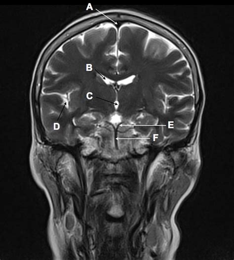 Normal Brain MRI Images