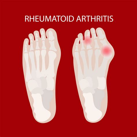 RHEUMATOID LEG Lesions Arthritis Educational Medicine Scheme 20432383 Vector Art at Vecteezy