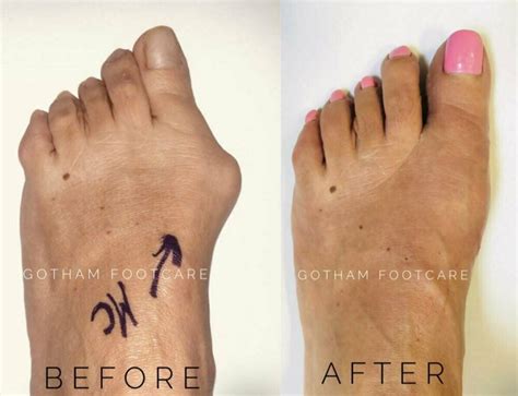 Why You Shouldn’t Ignore That Bunion Pain? Your Feet Will Thank You Later. | Gotham Footcare