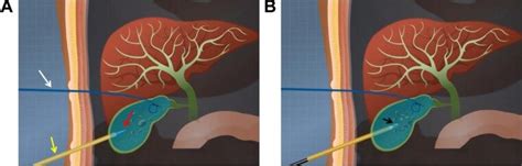 Percutaneous Cholecystostomy