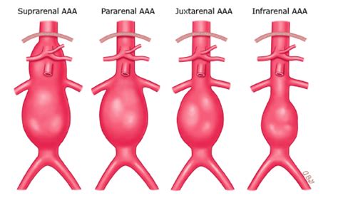 Abdominal Aortic Aneurysm Types