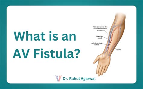 What is an AV Fistula