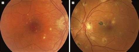 Punctate Inner ChoroidopathyClinical Features and Outcomes | Ophthalmology | JAMA Ophthalmology ...