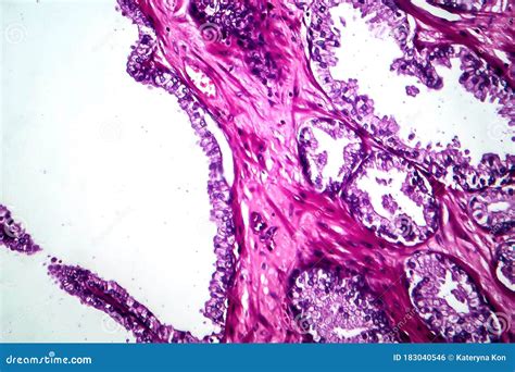 Prostate Cancer, Light Micrograph Stock Photo - Image of gland, eosin: 183040546