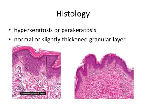 Ichthyosis Vulgaris Histology