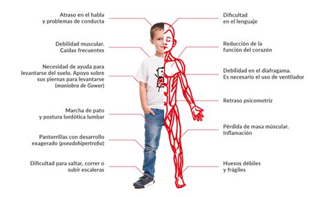 Síntomas - Duchenne Parent Project España