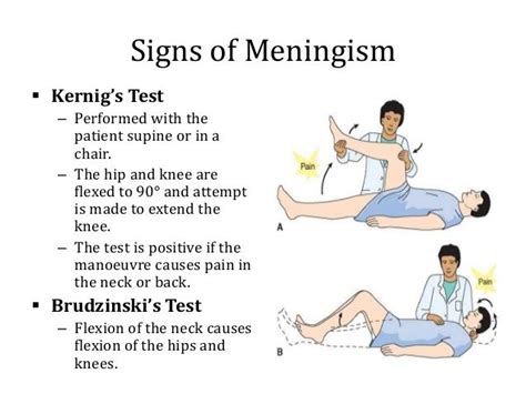 Kernig And Brudzinski Signs / Kernig/Brudzinski Test - YouTube / Two of the most commonly used ...