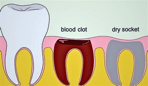 How To Prevent Dry Socket After Tooth Extraction?