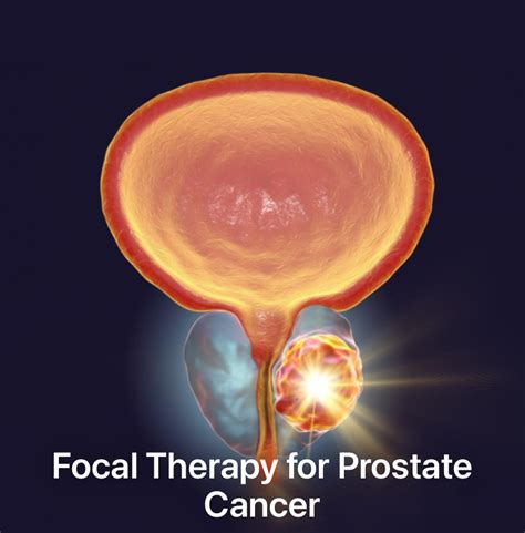 Home - prostatefocaltherapies.com