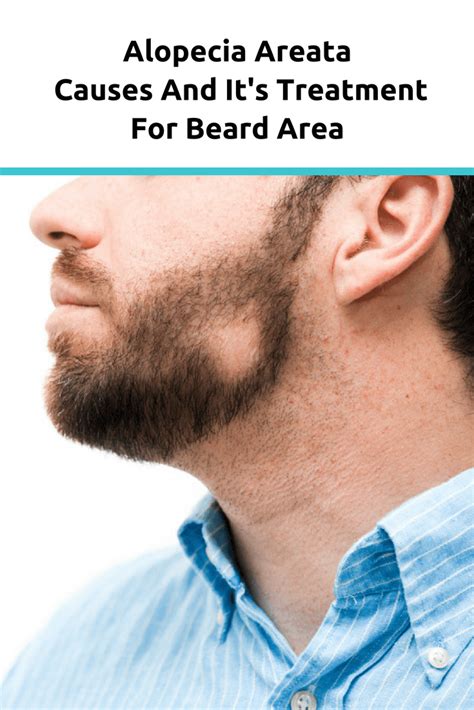 Alopecia Areata Causes And It's Treatment For Beard Area | Euromed® Clinic