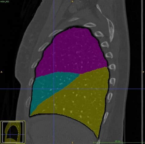 Lung Lobe Segmentation