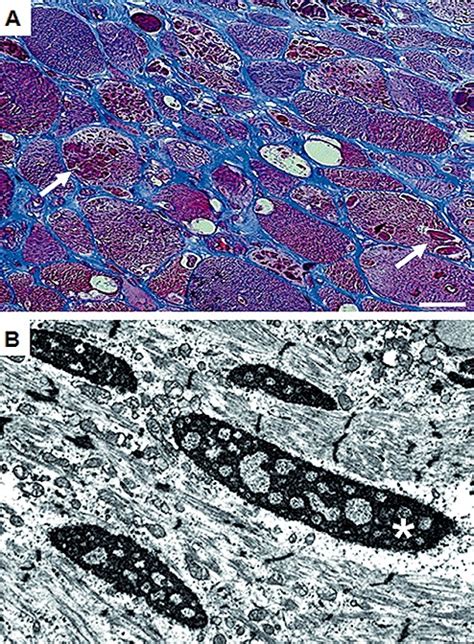 Reducing bodies are characterized by the presence of intracytoplasmic... | Download Scientific ...