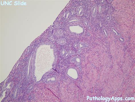 dysfunctional uterine bleeding pathology