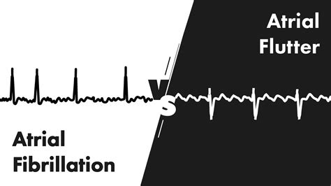 Atrial Fibrillation vs Atrial Flutter - ECG (EKG) Interpretation - MEDZCOOL - YouTube