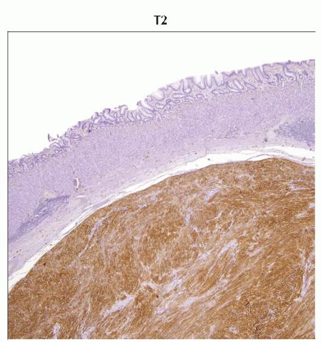 Gastrointestinal Stromal Tumor (GIST) | Radiology Key