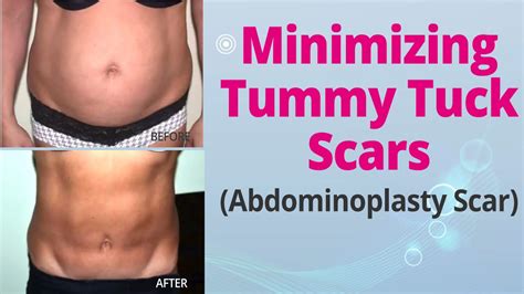 Minimizing Tummy Tuck Scars (Abdominoplasty Scar) - Edelstein Cosmetic - Toronto - YouTube