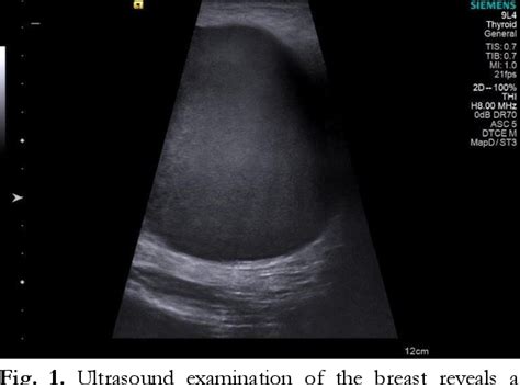 [PDF] Evaluation of Giant Galactocele With Ultrasound and Shearwave Elastography Findings ...