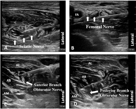 (A) Sciatic nerve block, (B) Femoral nerve block, (C) Anterior branch ...