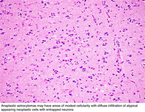 Pathology Outlines - Anaplastic astrocytoma, IDH wildtype