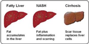 Treatments for Fatty Liver Disease | Nonalcoholic Fatty Liver Disease