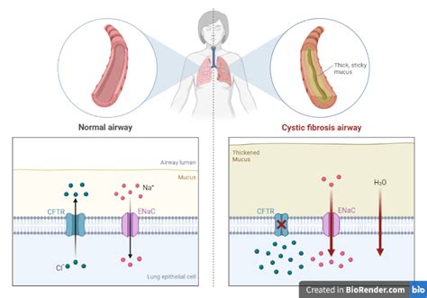 Cystic Fibrosis- Definition, Symptoms, Diagnosis, Treatment - Sciencevivid