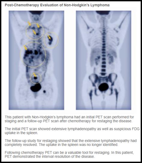 Lymphoma Stage 4 Cancer Pet Scan : Current Status Of Pet Ct In The ...