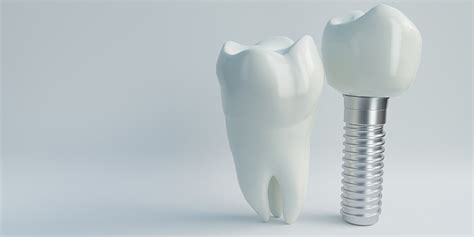 Why Titanium Is Used In Dental Implants | Dr. Alex Midtown NYC Cosmetic Dentist