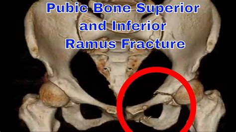 pubic bone superior and inferior ramus fracture - YouTube