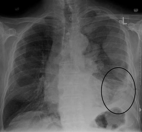 :::simple medicine:::: - Malignant Mesothelioma.