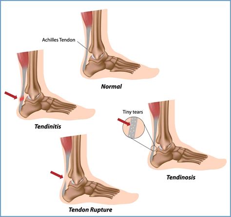 Achilles Tendon Repair – Yellowstone Surgery Center