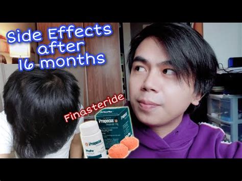 FINASTERIDE 16 months update for HAIR LOSS | SIDE EFFECTS - YouTube