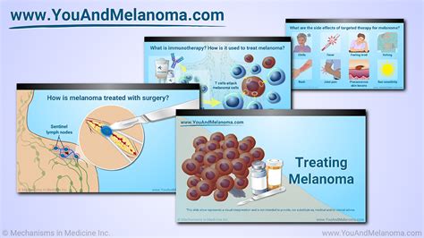 Slide Show - Treating Melanoma