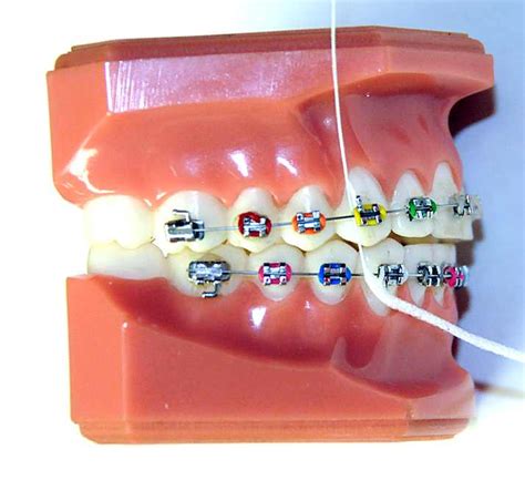 How Do You Floss with Braces? | Ask an Orthodontist.com