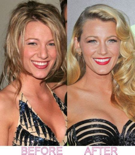 Blake Lively Plastic Surgery - True Beauty, Ugly Truth