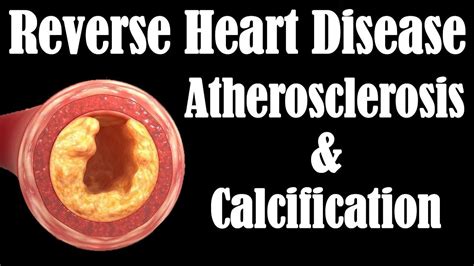 What causes Calcification? How to REVERSE HEART DISEASE! | Heart disease, Going vegan, Disease