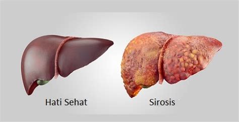 Cara Dokter Penang Mengobati Sirosis Hati