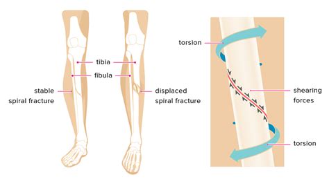 Spiral Fracture: Healing Time, Tibia, and Fibula