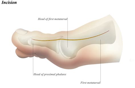 Dorsomedial Approach to MTP Joint of Great Toe : 네이버 블로그