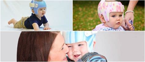 Plagiocephaly Helmet: Cranial Helmet Therapy, Ideal Moment for Helmet Therapy, Recommendations ...