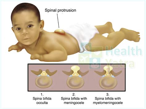 Spina Bifida Treatment in India: Causes, Signs & Symptoms - Updated 2023