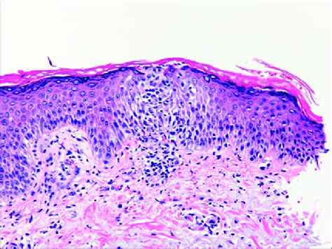 Epidermal spongiosis with spongiotic microvesicle formation. | Download Scientific Diagram