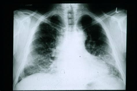 Una terapia con hormona tiroidea cura la fibrosis pulmonar - El médico interactivo