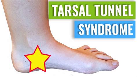 Tarsal Tunnel Syndrome Exercises