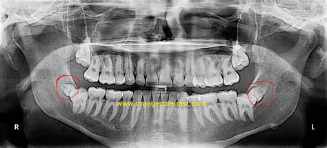 Supernumerary Teeth | Calcaterra Family Dentistry | Extra Tooth Orange