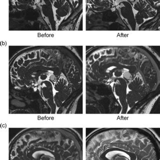 Intraoperative pictures obtained during pineal cyst (PC) removal... | Download Scientific Diagram